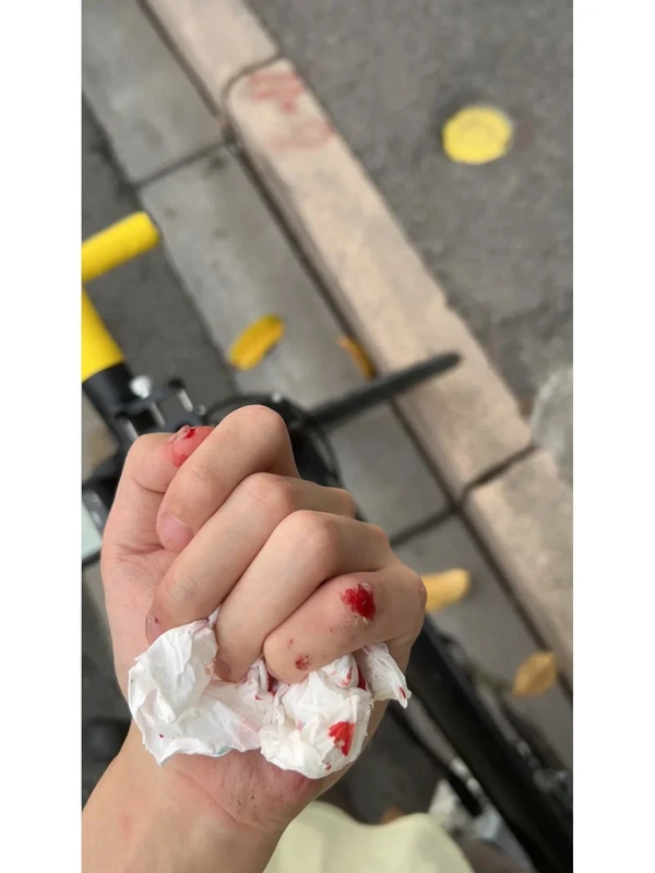 ảnh ngã xe trầy tay (3)